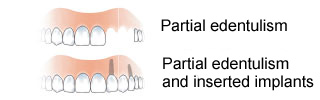 edentulia-parziale-en
