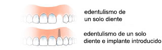 monoedentulia-es