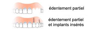 edentulia-parziale-fr