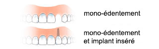 monoedentulia-fr