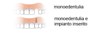 monoedentulia