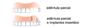 edentulia-parziale-pt