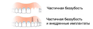 edentulia-parziale-ru