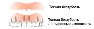 protesi-fissa-ru